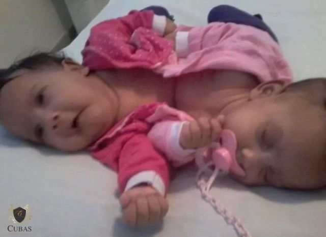 INSS concede o benef�cio assistencial (BPC/LOAS) a g�meas siamesas