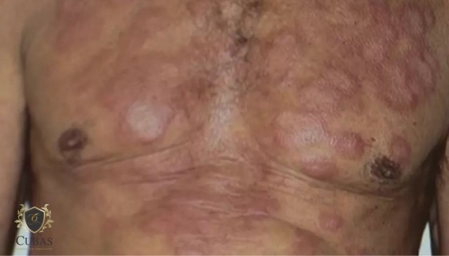 TRF3 garante aposentadoria por invalidez a portador de hansen�ase