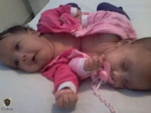 INSS concede o benef�cio assistencial (BPC/LOAS) a g�meas siamesas