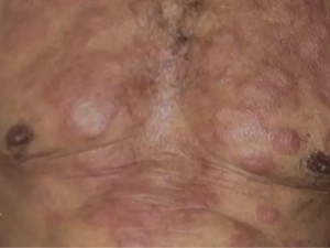 TRF3 garante aposentadoria por invalidez a portador de hansen�ase